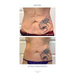 T shape 2 firming loose skin