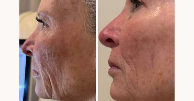 Skin Tightening Treatments: Achieve Smoother, Firmer Skin with T-Shape 2 Non-Invasive Technology