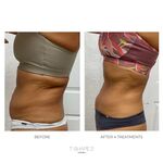 T shape 2 body sculpting treatment